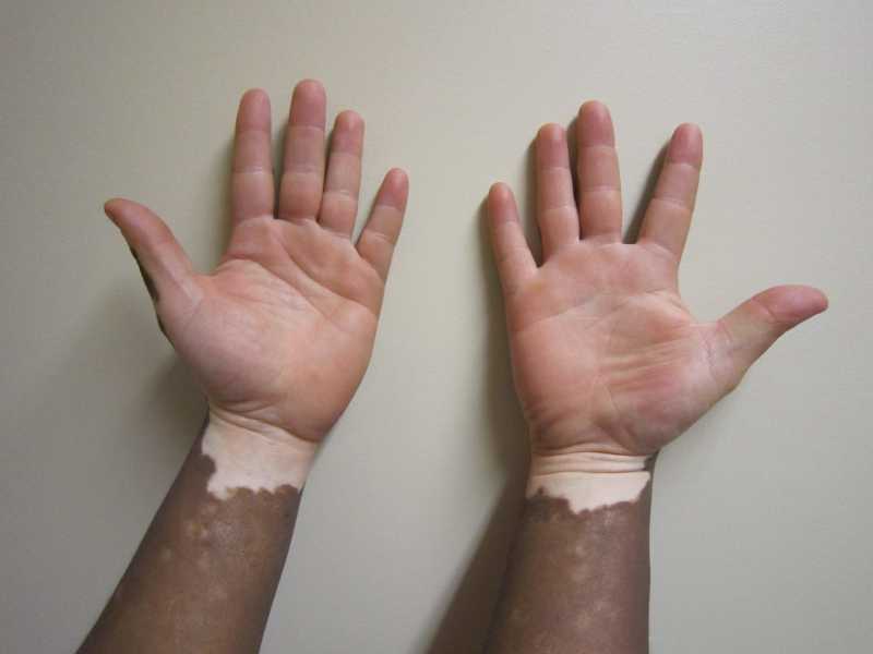 Vitiligo1.jpg